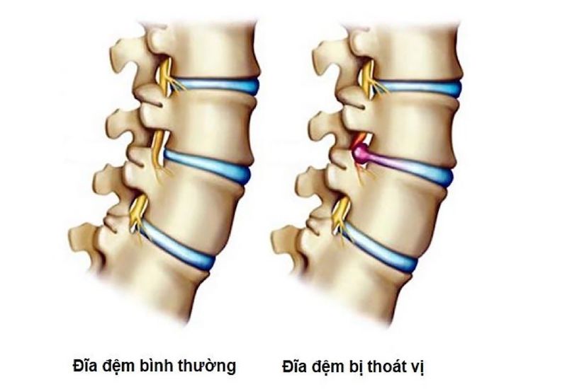 Chữa thoát vị đĩa đệm cột sống cổ