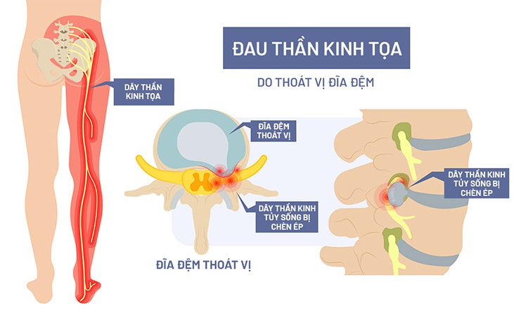 Đau thần kinh tọa