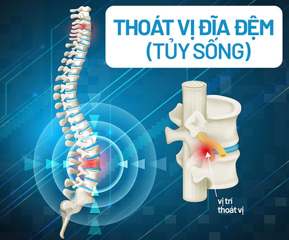 Vị trí thoát vị đĩa đệm