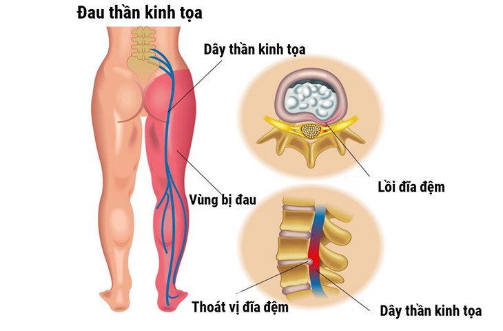 SAU TUỔI 30, ĐỀ PHÒNG ĐAU THẦN KINH TỌA